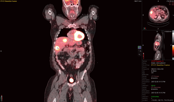 MIM Encore | Oncologic PET | Imagine a New Reading Workflow