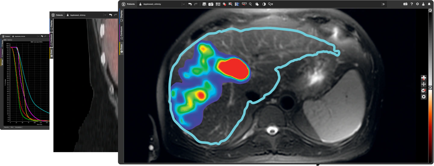 3 SurePlan LiverY90 windows displaying liver contours, dose, and a DVH chart