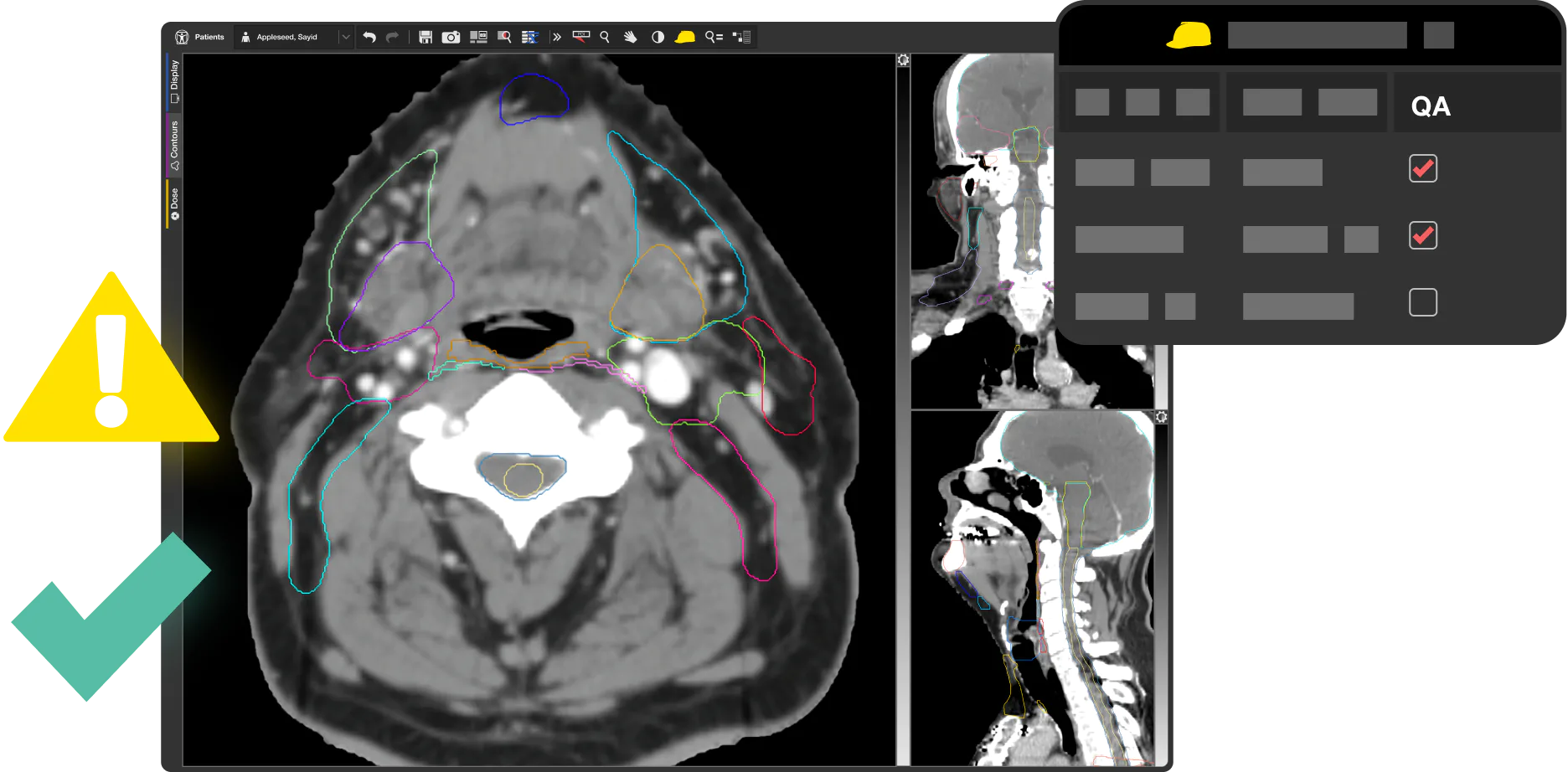 Contour QA in MIM Maestro. Alert and checkmarks over contoured head and neck radiation oncology case.