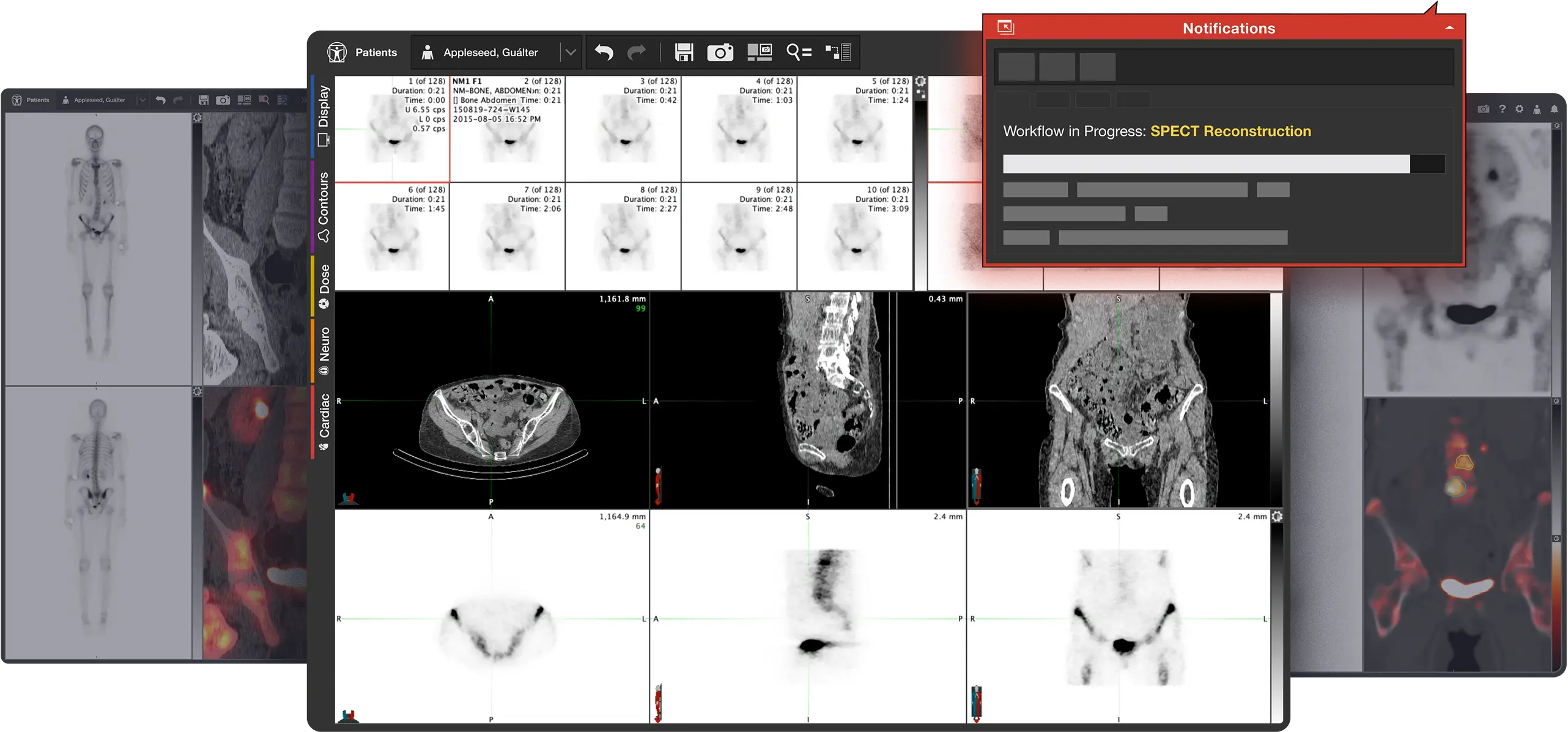 SPECT images in a reconstruction process displayed within the MIM Encore application